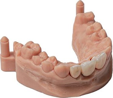 Multi-site implant restoration
