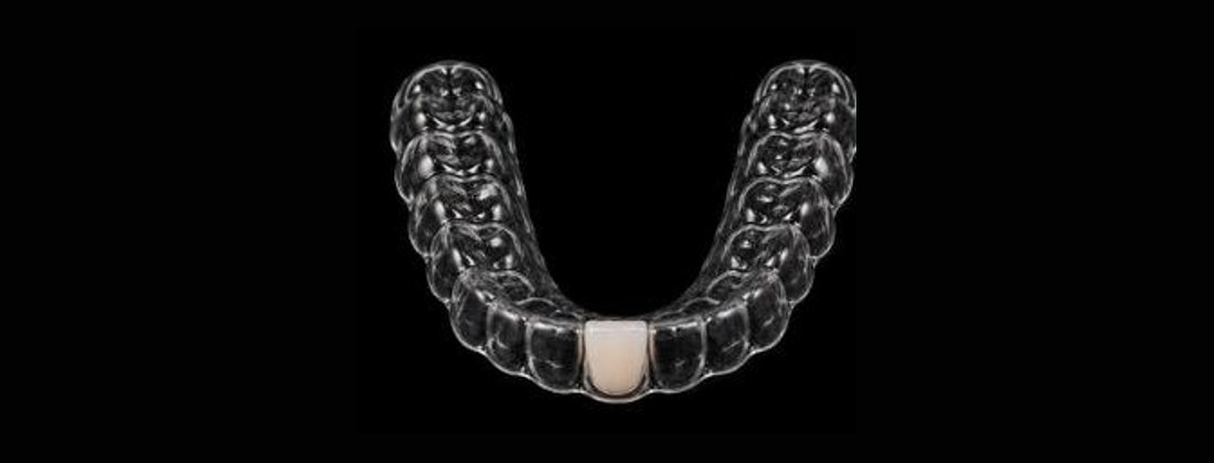 Essix retainer